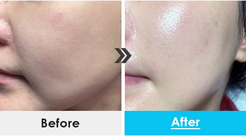 Кожа после нанесения крема Medi peel Power Aqua H8 Cream