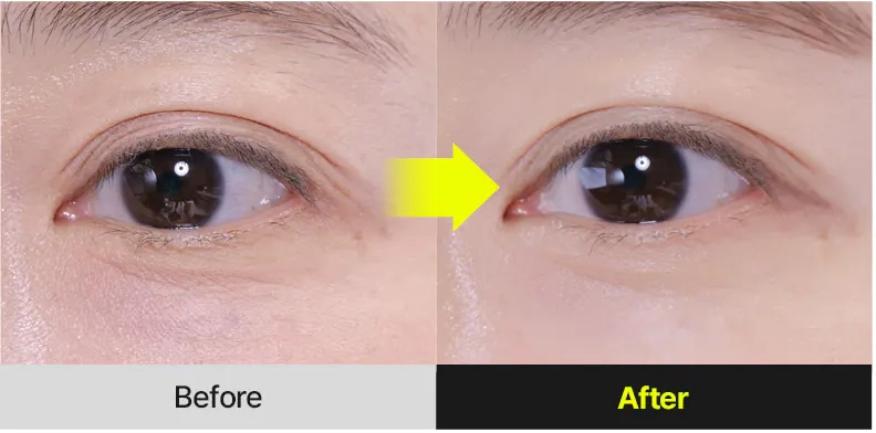 Результаты использования Medi peel Retinal NMN Bounce Shot Eye Cream
