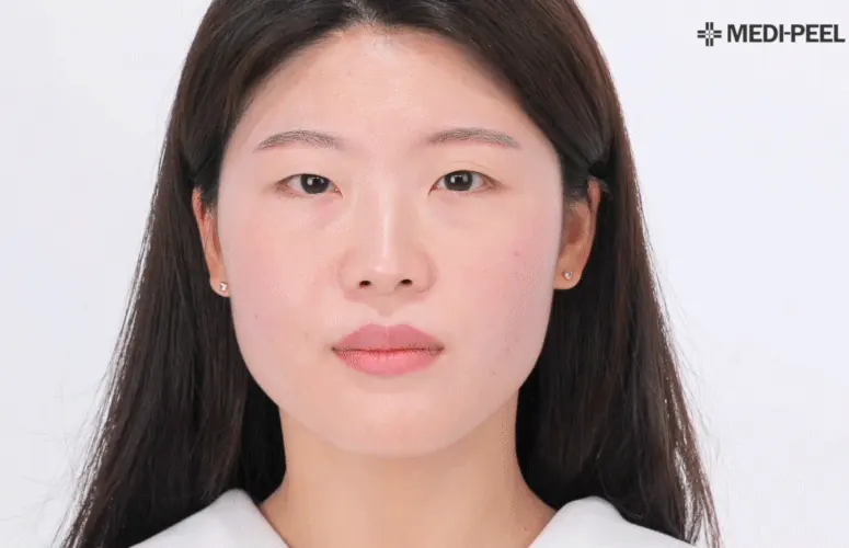 Результати використання серії засобів Medi Peel Retinol Collagen Lifting